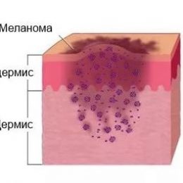 Лечение меланомы