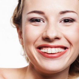 Съемный аппарат для исправления прикуса – альтернатива брекетам